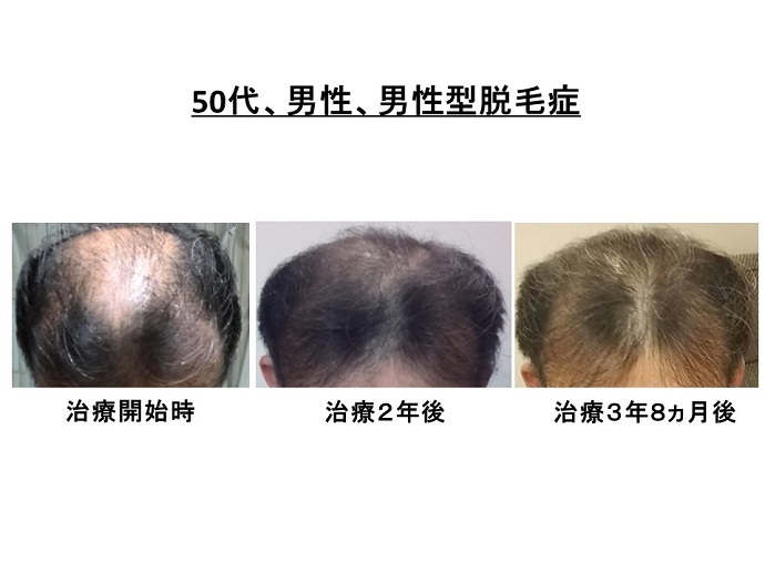 円形脱毛症　病院